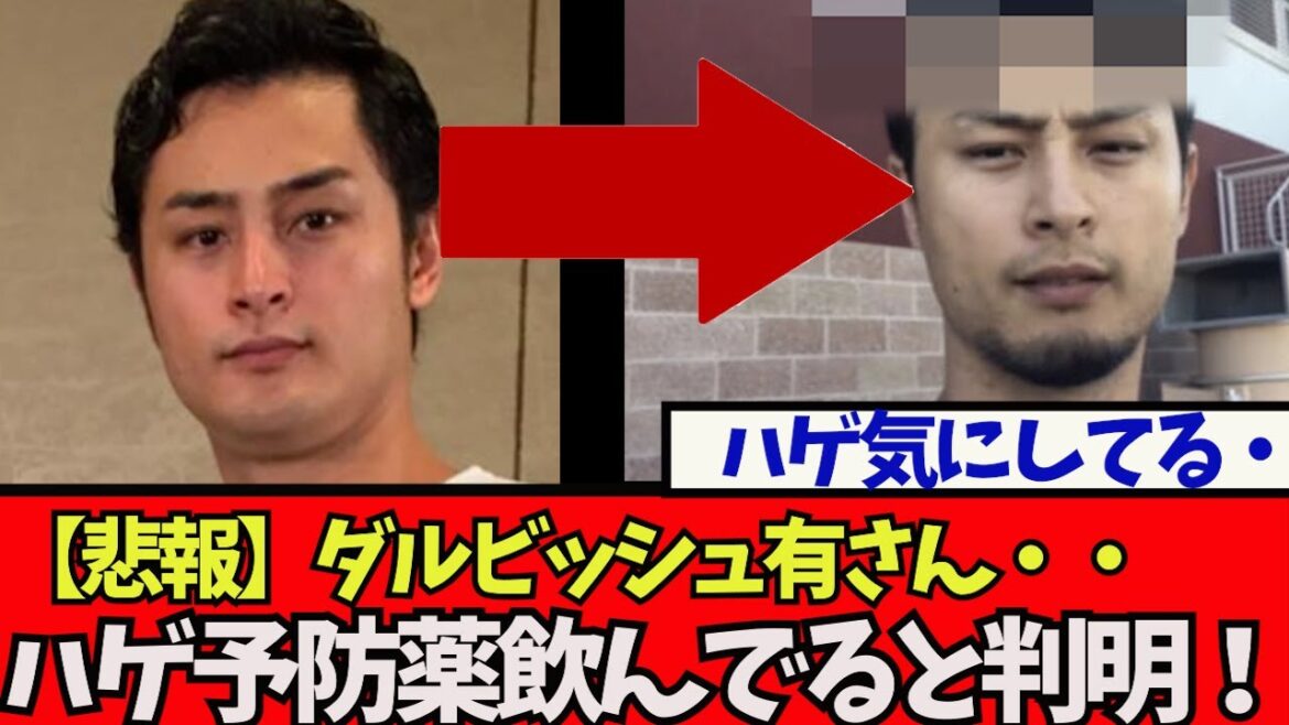 [Triste nouvelle]M. Darvish, il s'avère qu'il prenait des médicaments préventifs contre la calvitie parce qu'il s'inquiétait pour ses cheveux wwwww