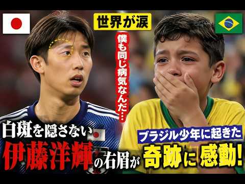 Le monde est en larmes : Hiroki Ito ne cache pas son vitiligo… Le miracle que son sourcil droit a causé à un garçon brésilien continue d’impressionner ! amour Le monde est en larmes : Hiroki Ito ne cache pas son vitiligo... Le miracle que son sourcil droit a causé à un garçon brésilien continue d'impressionner ! amour